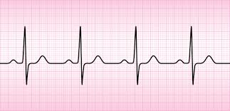 panic attack vs heart attack normal ECG